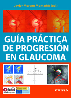 Guía práctica de progresión en glaucoma